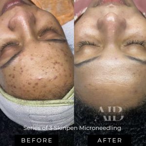 What is Microneedling?