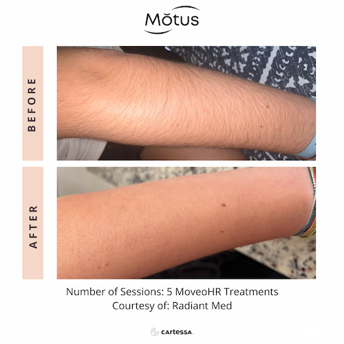 Motus AZ+ laser hair removal technology
