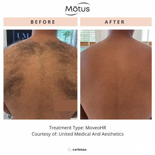 Motus AZ+ laser platform at Allure Infinite Beauty