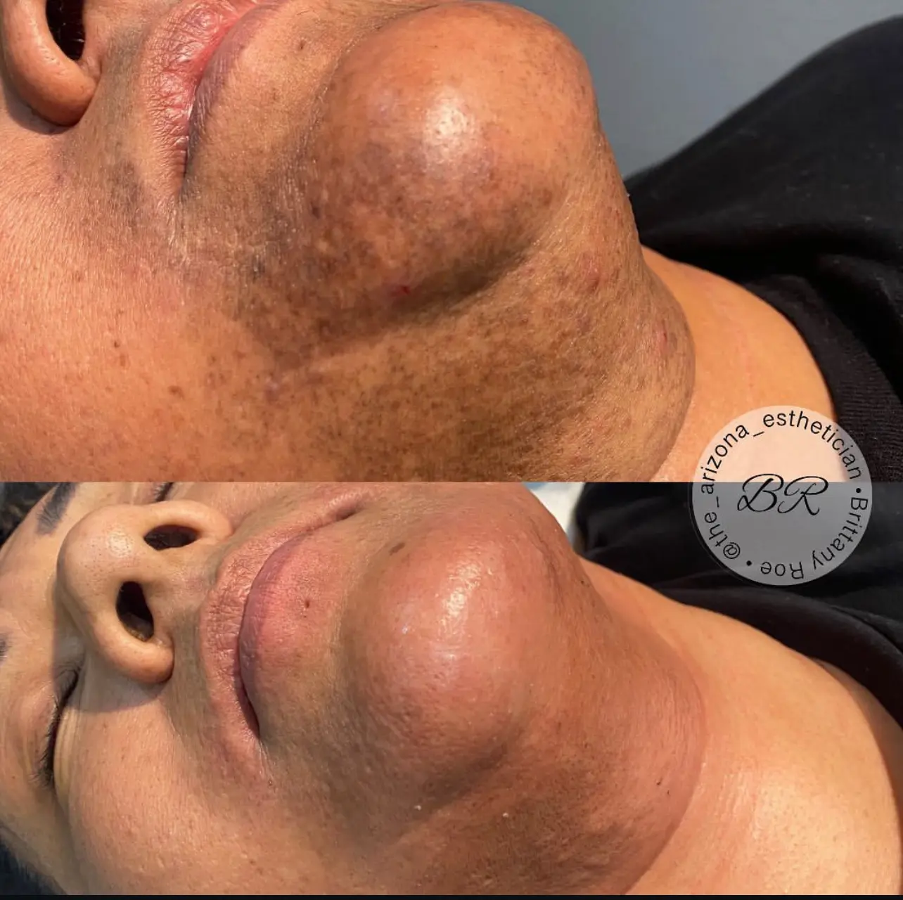 laser hair removal