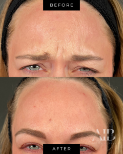 before and after botox - between brows