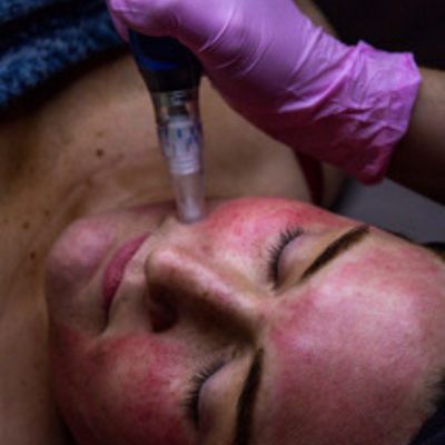 Microneedling treatment on face