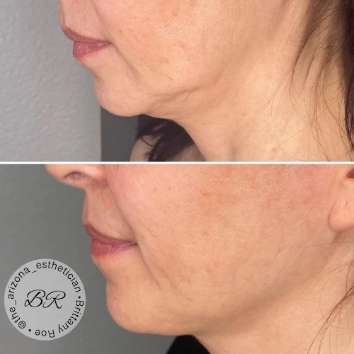 CoolPeel CO2 laser before and after at Allure Infinite Beauty in Mesa, AZ