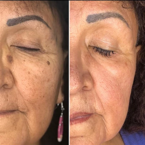 CoolPeel CO2 laser before and after at Allure Infinite Beauty in Mesa, AZ