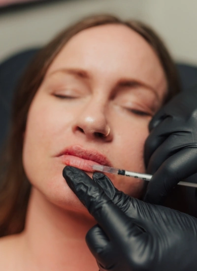 Lip filler cosmetic injection treatment in Mesa, AZ