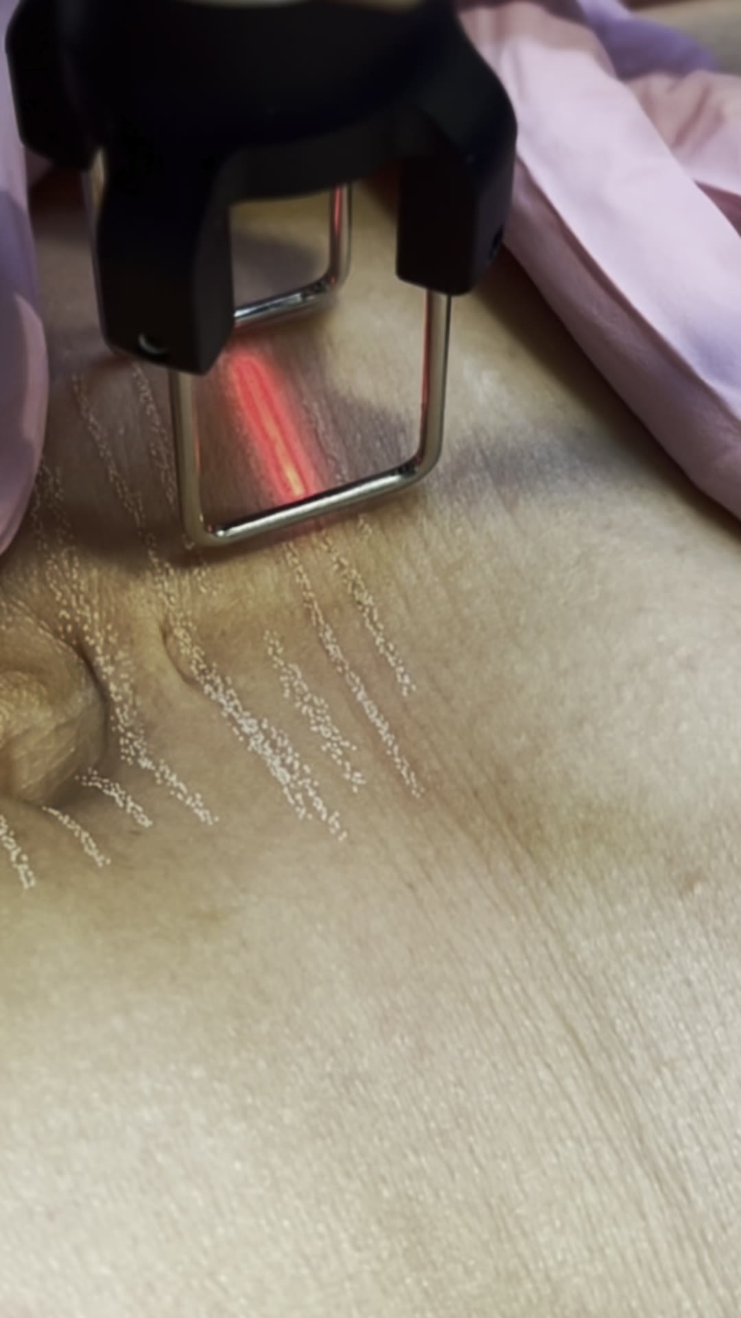 Our licensed provider guides the Tetra CO2 handpiece across the treatment area. The red aiming beam and square tip are characteristic of the CoolPeel/Tetra platform used at our Mesa med spa. at Allure Infinite Beauty in Mesa, AZ