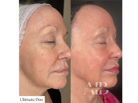 How Much Downtime Does CO2 Laser Resurfacing Really Have?