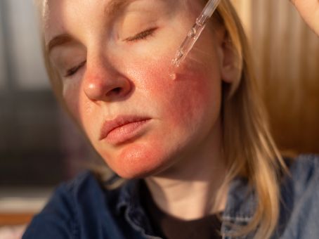 Fractional CO2 Laser Recovery: Day-by-Day Healing Guide