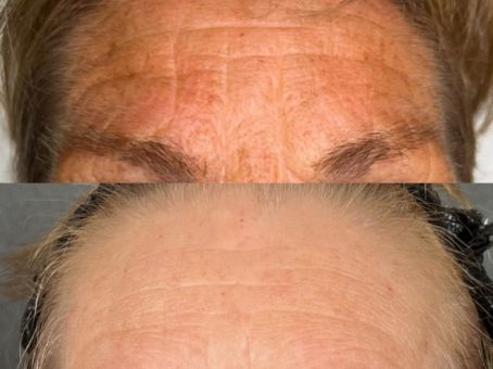 CoolPeel Recovery: Day-by-Day Healing Guide