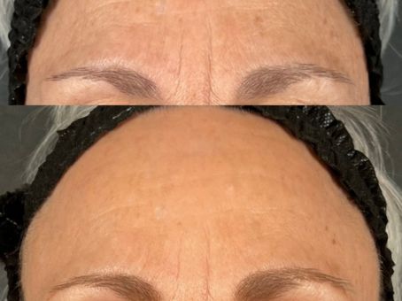 How Many CoolPeel Treatments Do You Need?