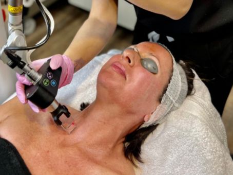CO2 Laser for Wrinkles, Crepey Skin & Sun Damage