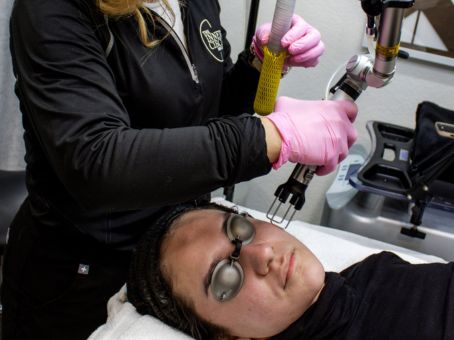 CO2 Laser for Acne Scars: Does It Really Work?