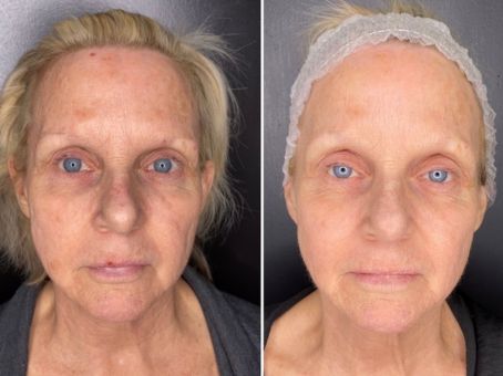 What Is CoolPeel? Benefits, Downtime & What to Expect