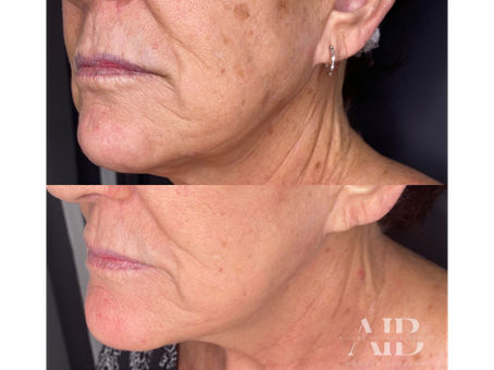 Can CO2 Laser Tighten Skin? What Results Can You Expect?