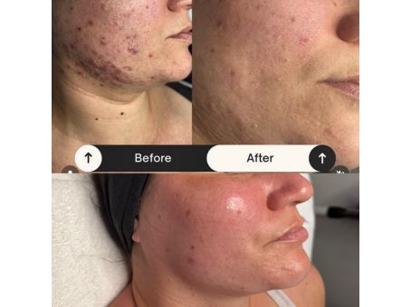 Best Treatments for Acne Scars in Mesa, AZ