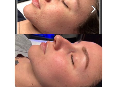 Best Treatments for Enlarged Pores and Uneven Skin Texture