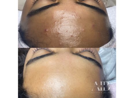 Ice Pick vs Boxcar vs Rolling Acne Scars: What’s the Difference?