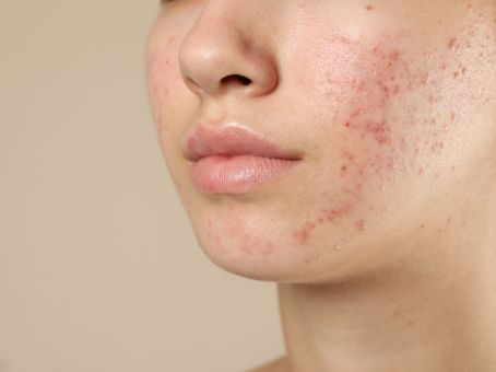 Acne Treatment for Women in Their 30s, 40s & 50s