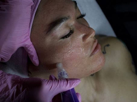 Can You Get Microneedling If You Still Have Active Acne?
