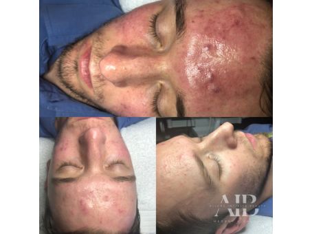 How Long Does It Take to Clear Acne?