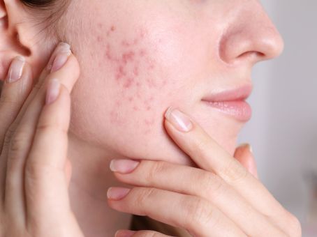 Hormonal Acne vs Regular Acne: How Can You Tell?