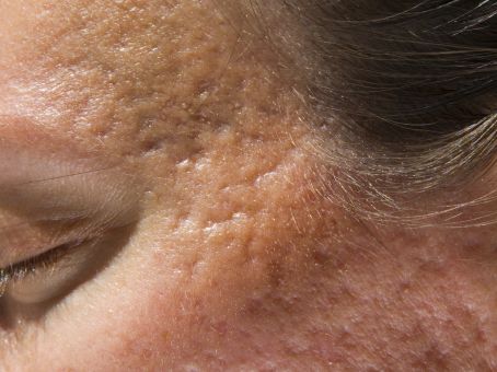 How to Treat Post-Inflammatory Hyperpigmentation After Acne