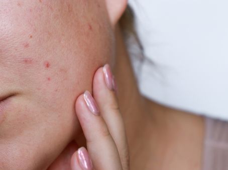 Acne Scars vs Acne Marks: What’s the Difference?