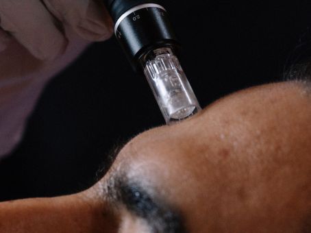 RF Microneedling for Acne Scars: How It Works & Who It’s Best For