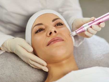 Microneedling for Acne Scars: Does It Work?