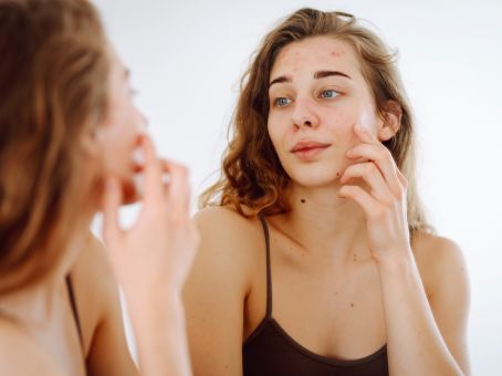 Acne Treatment in Mesa, AZ: Causes, Treatments & What Actually Works